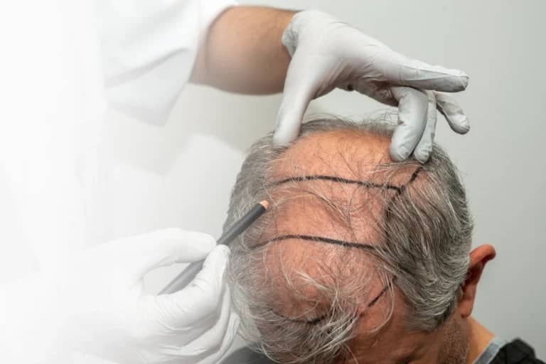 DHI Hair Transplant